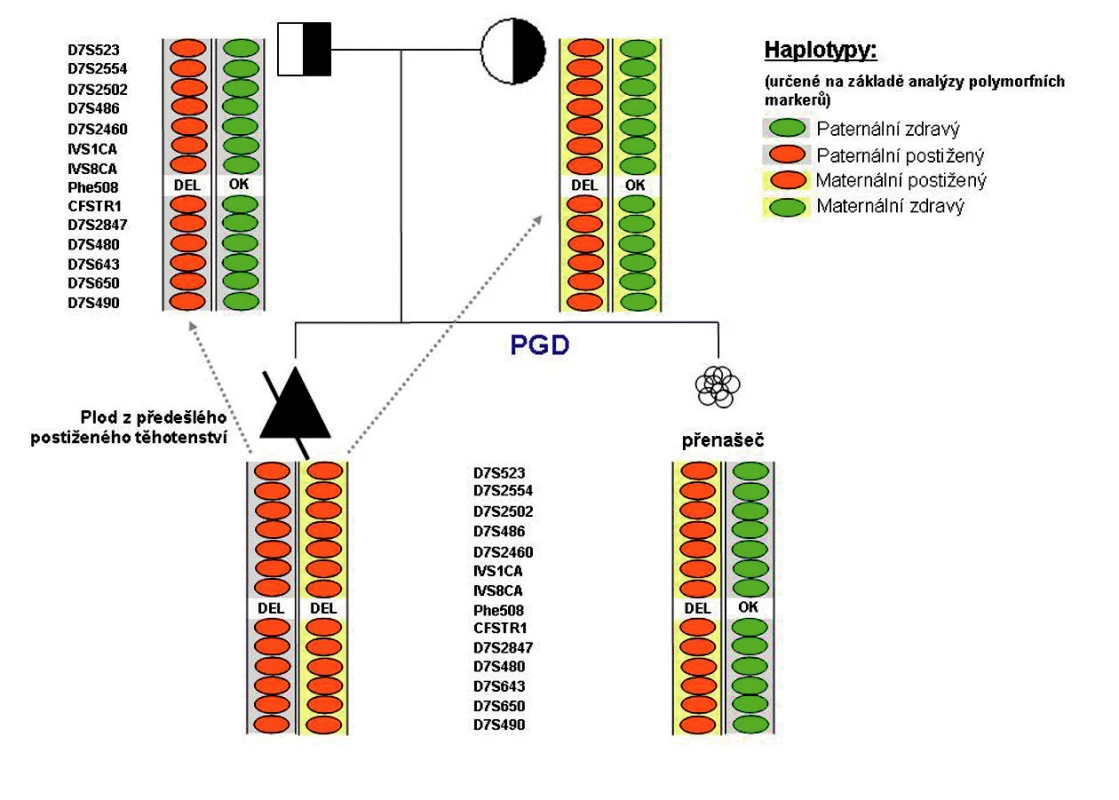 Příklad CFTR-PGH provedené na našem pracovišti: 
Oba partneři byli přímou analýzou diagnostikováni jako heterozygoti pro mutaci F508del. Analýza polymorfních markerů plodu z předešlého postiženého těhotenství umožnila určení rodičovských haplotypů, tj. bylo možné jednoznačně určit, který polymorfismus se váže se zdravou a který s postiženou alelou vyšetřovaného genu u daného rodiče. Tyto jednoznačně informativní polymorfismy jsou pak vyhledávány u vyšetřovaných embryí. V rámci preimplantační diagnostiky provedené na našem pracovišti bylo jedno z vyšetřovaných embryí (nesoucí mutaci F508del v heterozygotním stavu) páru určeno jako vhodné k transferu.