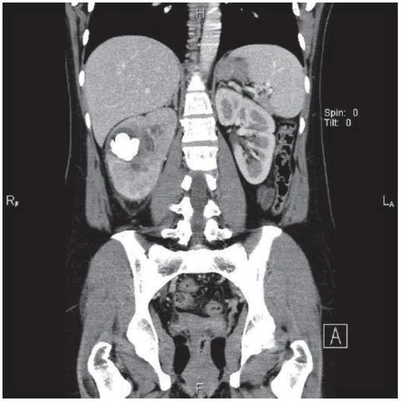 CT snímek tumoru
Fig. 1. CT of tumou