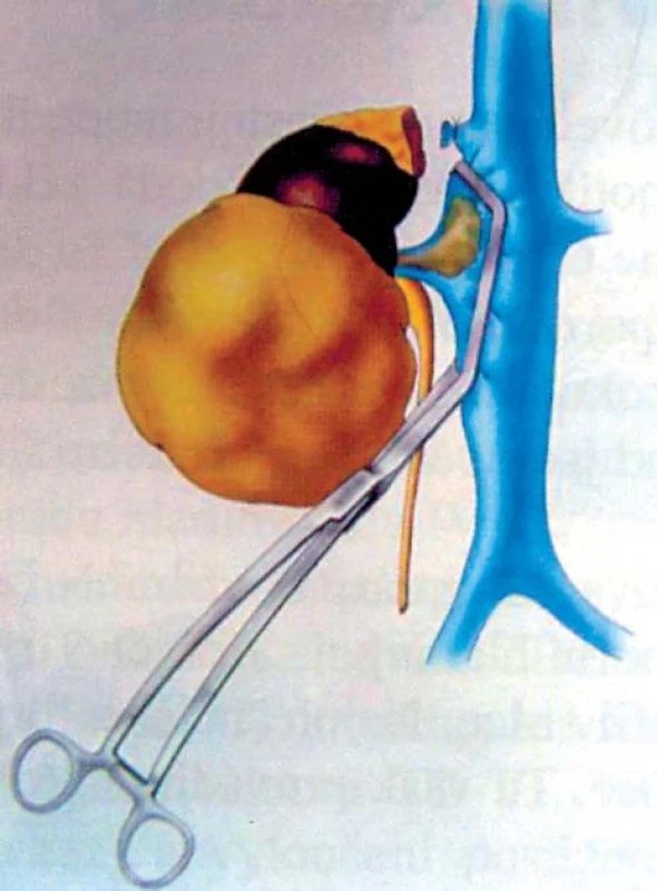 Tumor pravé ledviny s trombem hladiny I–II (nasazení Satinského svorky) [24].