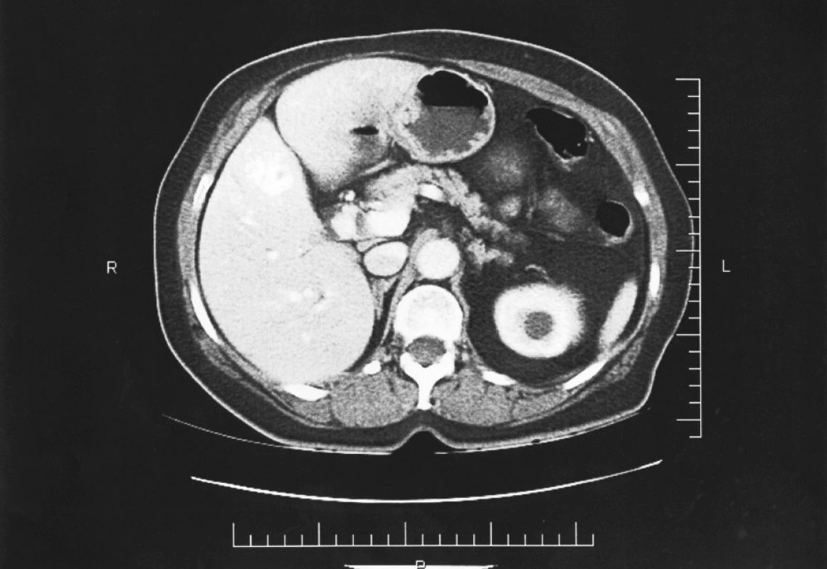 Předoperační CT jater s metastázou
Fig. 2. Preoperative liver CT with a metastasis