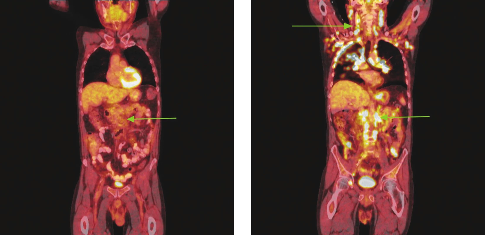 Série PET/CT snímků u nemocného s difuzním B-velkobuněčným lymfomem po imunochemoterapii a při relapsu choroby o 18 měsíců později. Na prvním snímku po léčbě nalezeny pouze zvětšené lymfatické uzliny mediastina a měkkotkáňová masa v retroperitoneu podél aorty od odstupu renálních tepen po bifurkaci nevykazující hypermetabolismus glukózy. Pro kumulaci rizikových faktorů indikována radioterapie na zbytkovou masu retroperitonea. Na druhém snímku obraz relapsu choroby, kdy nalezeny mnohočetné zvětšené lymfatické uzliny na krku, v oblasti tonzil, v axilách, ve všech oddílech mediastina, v retroperitoneu podél aorty a dolní duté žíly splývající v pakety, v lymfatických uzlinách na mezenteriu, podél pravé ilické tepny, dále pak ve vícečetných ložiscích obou plic a ve skeletu pravého acetabula vykazující hypermetabolismus glukózy.