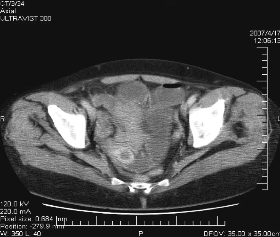 CT = hypodenzné ložisko v malej panve vpravo
Fig. 6. CT = a hypodense focus within the small pelvis on the right