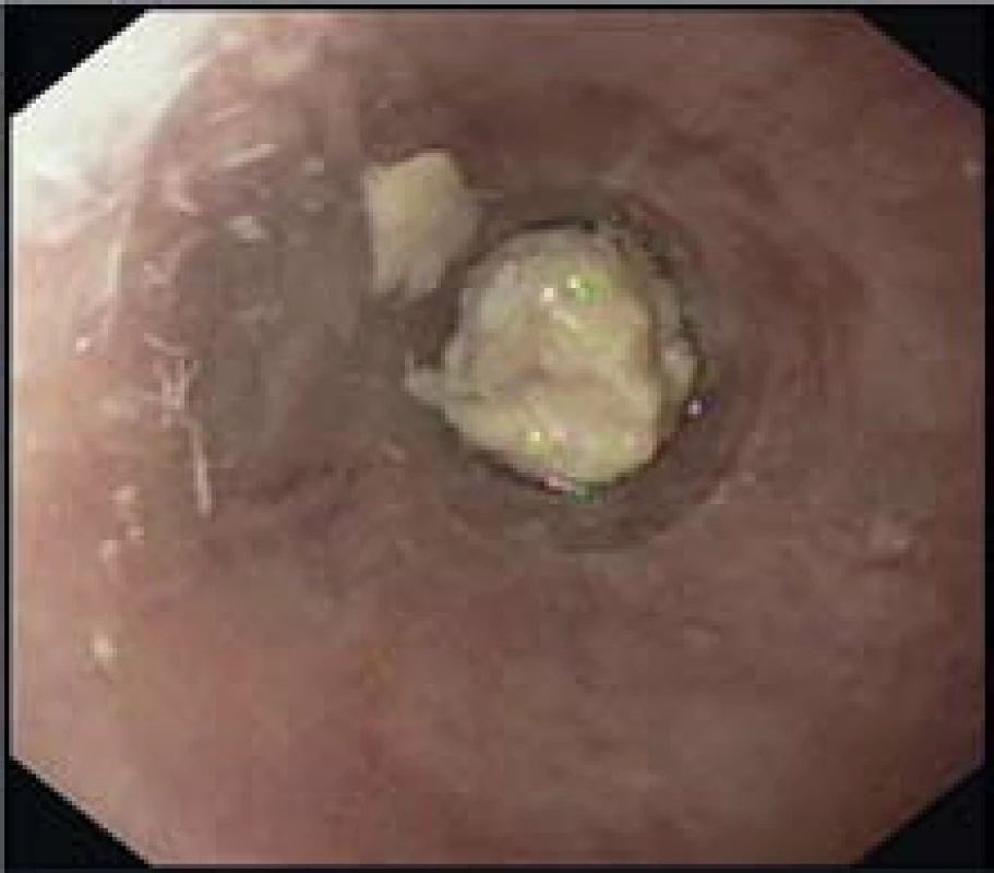 Zaklíněné tuhé sousto u pacienta s dg. EoE ve zúženém distálním jícnu.
Fig. 9. Impacted solid food in a patient with EoE in the narrow distal esophageal.