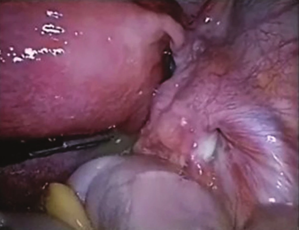 Seropurulentní výpotek kolem těhotné dělohy, těhotná děloha je vidět vlevo
Fig. 4: Seropurulent exudate around the gravid uterus, gravid uterus seen on the left