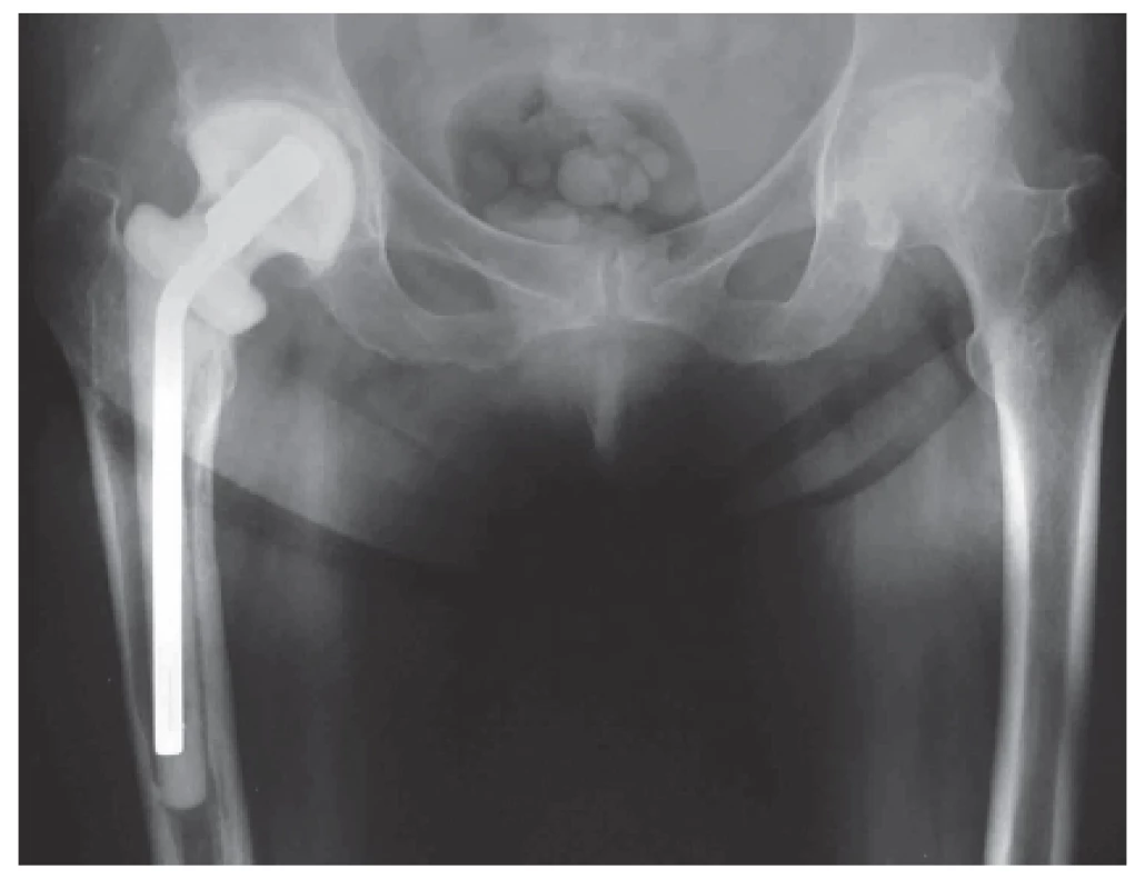 Rentgenový snímek implantovaného ready-made spaceru kyčelního kloubu. Významnou výhodou je zachování délky končetiny.
Fig 1. An X-ray of an implanted ready-made total hip spacer, having the advantage of preserving limb length.