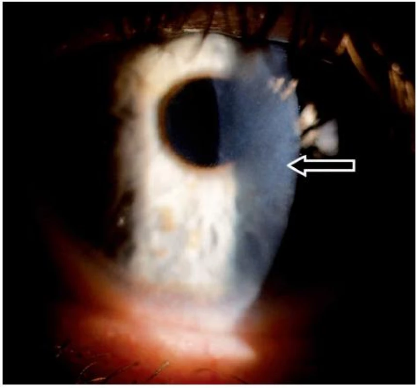 Subepiteliální fibróza – levé oko