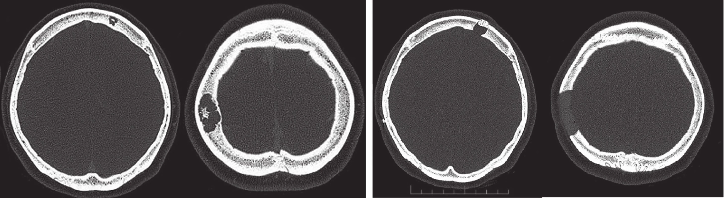 CT hlavy před a po neurochirurgickém zákroku, vybrané transaxiální řezy – osteolytická ložiska v kalvě frontálně vlevo a parietálně vpravo.