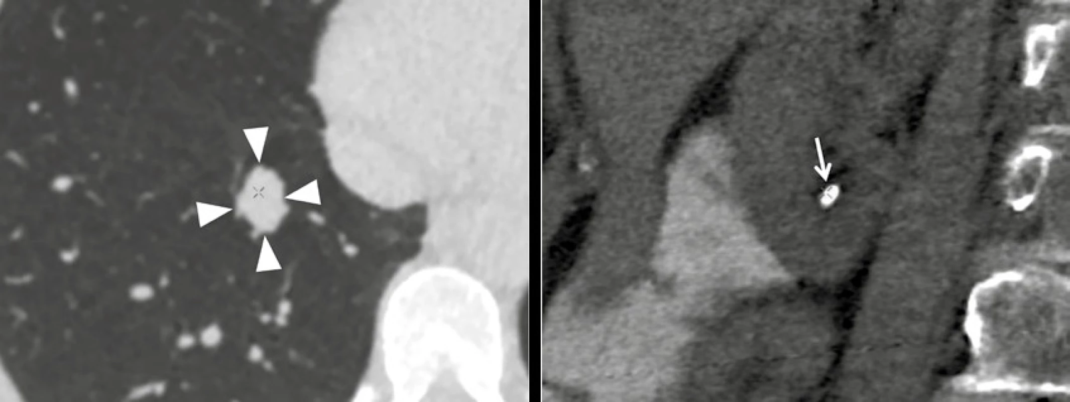 Extrakolonické nálezy při CT kolografii. Uzel v pravém dolním laloku plicním velikosti 19 × 14 mm (C-RADS E4, vlevo), pravostranná nefrolitiáza v dolním kalichu (C-RADS E2, vpravo)