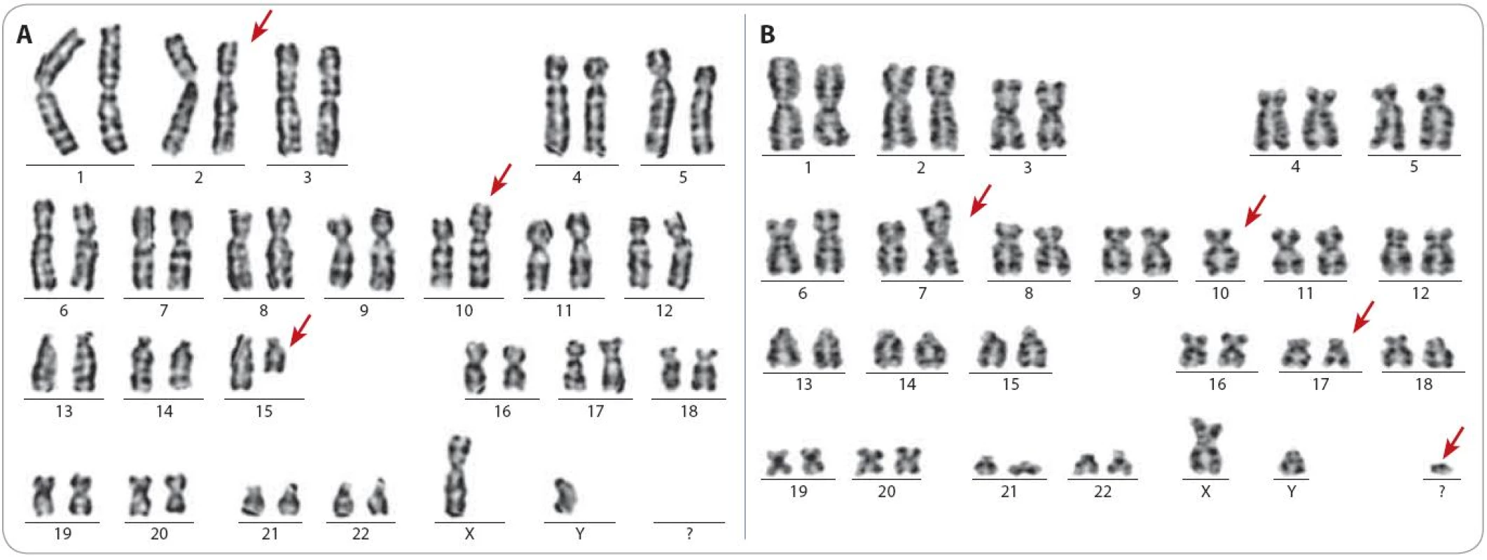 Ukázka karyotypu dvou pacientů s komplexními změnami. Červenými šipkami jsou označeny aberantní chromozomy.