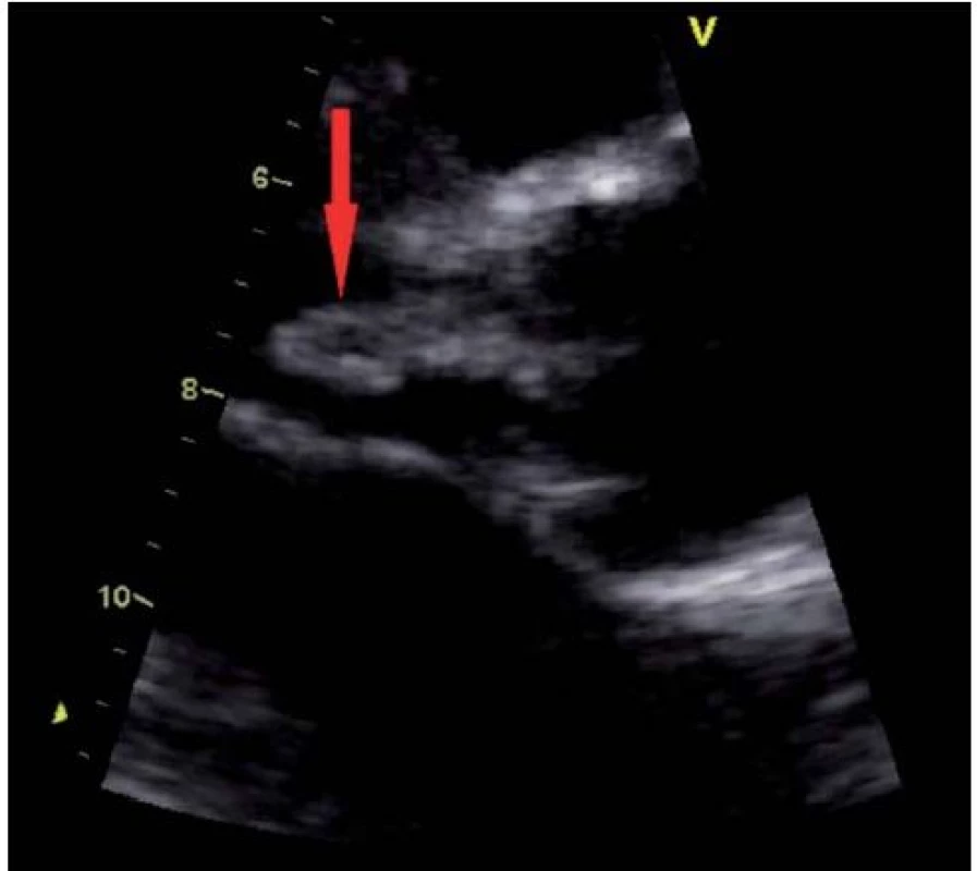 Vlající vegetace na pravém koronárním cípu aortální chlopně (transtorakální echokardiografie – parasternální projekce na dlouhou osu).