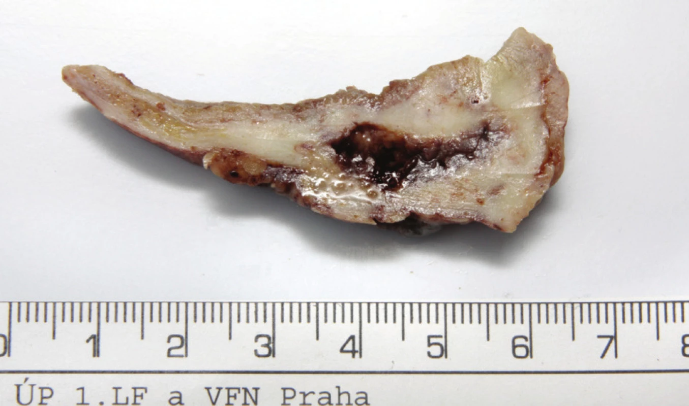 Fotografie – průřez stěnou žlučníku s nálezem ve fundu
Fig. 4. Photo – section through the gall bladder wall with a finding in the fundus