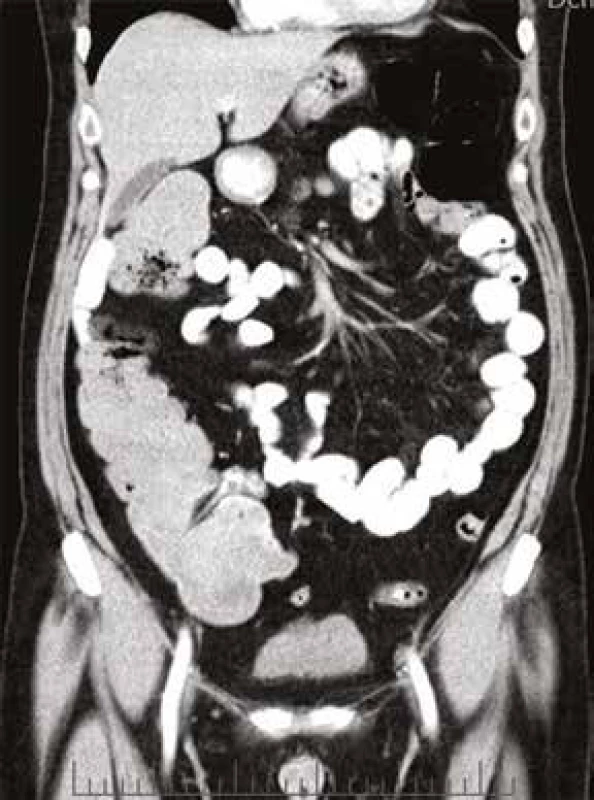CT břicha, koronární scan: výrazná distenze tračníku, v céku dosahuje až 9 cm