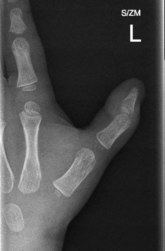 Rentgenové vyšetření palce – bez známek poranění skeletu