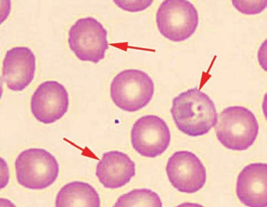 Detail nátěru periferní krve pacienta č. 2 s ojedinělými echinocyty. 
Fig. 4. Detail of the patient’s peripheral blood smear No. 2 with isolated echinocytes.