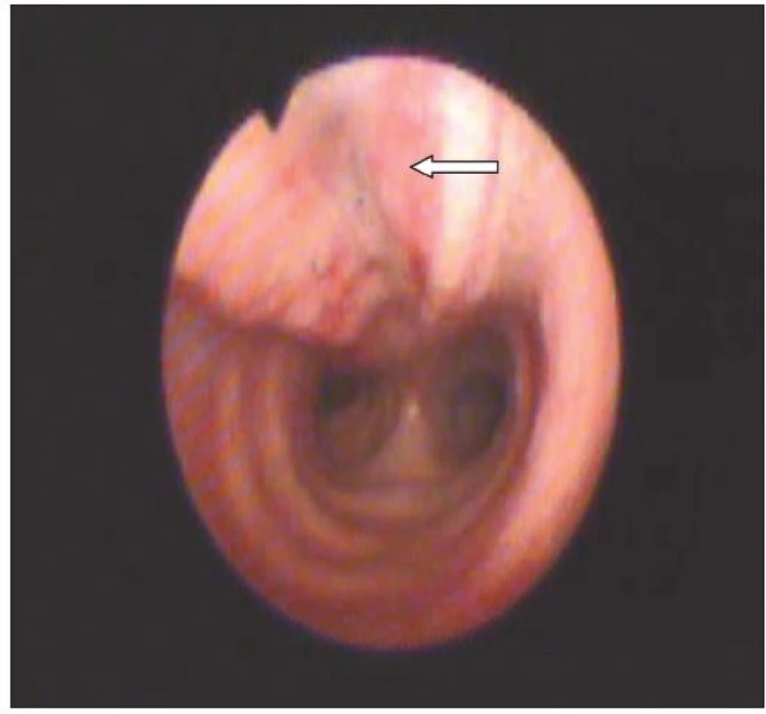 Druhý případ, 7. den poranění BSK patrný prolaps (šipka) po ruptuře pars membranacea trachey v distální části, zasahující až nad karinu