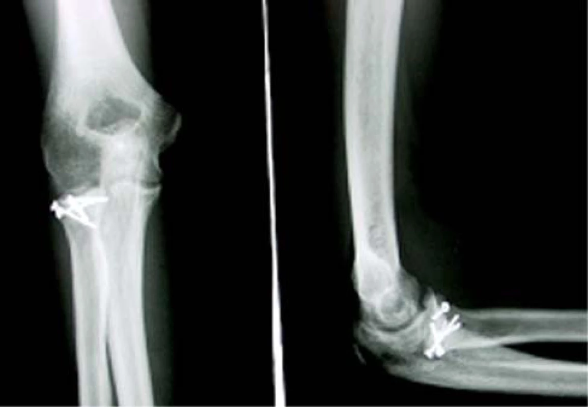 Zlomenina typu Mason II po osteosyntéze miniskrutkami.