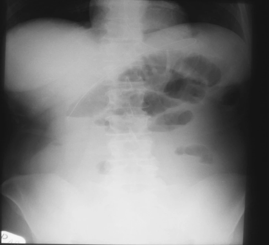 NSB – 19. 4. 2007 = kontrola pri zhoršení stavu – indikácia k OP
Fig. 5. Native abdominal x-ray view – 19-04-2007 = a checkup upon deterioration of the patient’s condition – indication for surgery