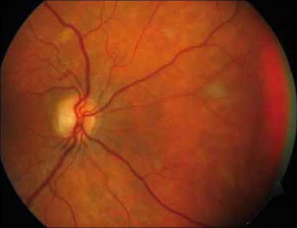 Projevy ischemie v nazálních kvadrantech sítnice pravého oka.