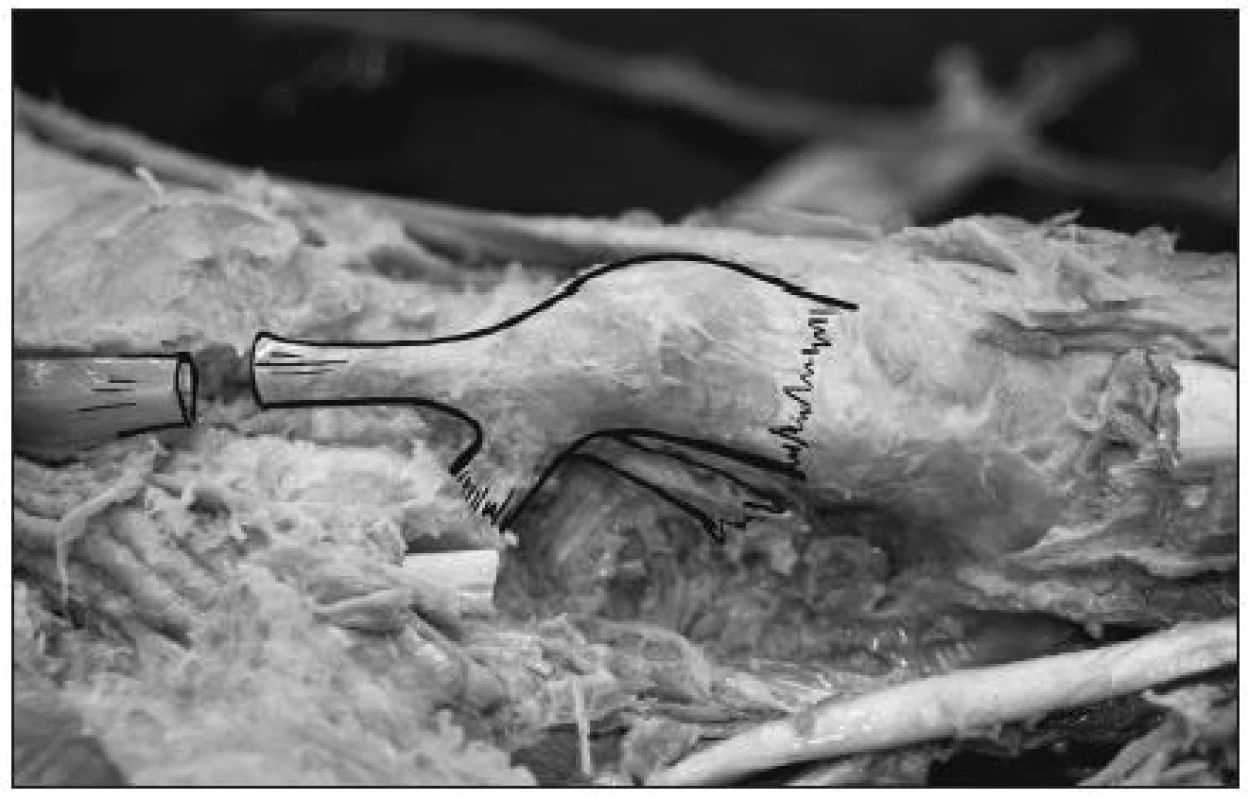 Anatomická studie úponu šlachy m. tibialis posterior na os naviculare pedis.