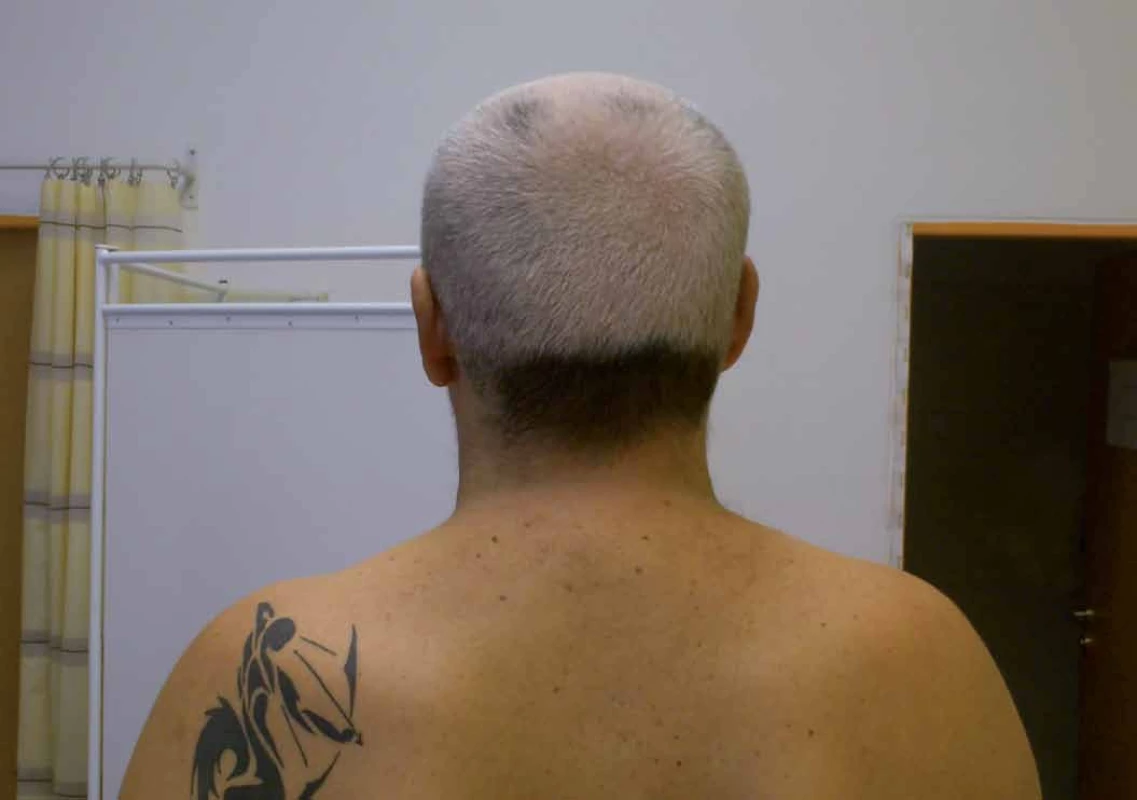 Depigmentace vlasů jako vedlejší účinek onkologické léčby.