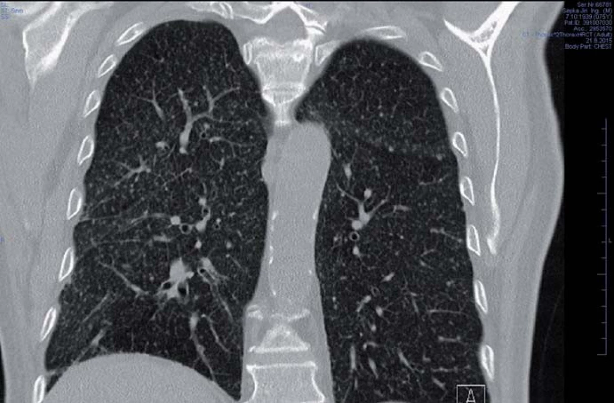 HRCT plic s nálezem mikronodulárního procesu typického pro tuberkulózní postižení.
Fig. 3. HRCT scan of lungs with micronodular process typical of tuberculosis.