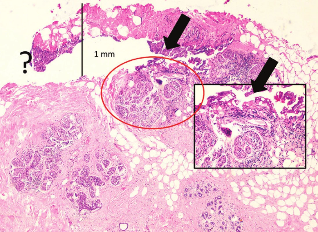 DCIS a kancerizace lobulů v termicky změném okraji resekátu (HEO 40x)
Fig. 2: DCIS and cancerization of lobules in the resection margin of the lumpectomy with thermal changes (HEO 40x) Okraj resekátu s naříznutím (černé šipky), DCIS s termickými změnami v naříznutém okraji (červený kruh a detail v rámečku HEO 100x). V místě otazníku zcela nečitelný buněčný okrsek. V reexcizi byl zastižen excesivní DCIS.