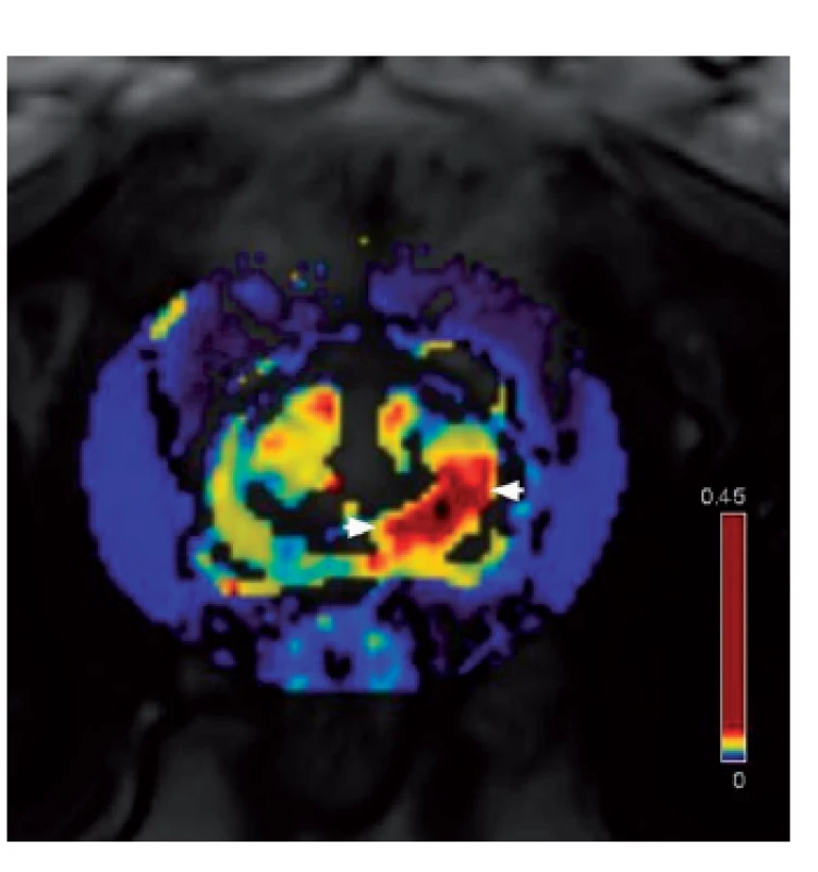 Farmakodynamická analýza – ložisko hypervaskularizace v levém periferním laloku jako známka karcinomu 
Fig. 2. DCE (dynamic contrast enhanced) MRI – tumor focus in the left peripheral zone (region of hypervascularization)