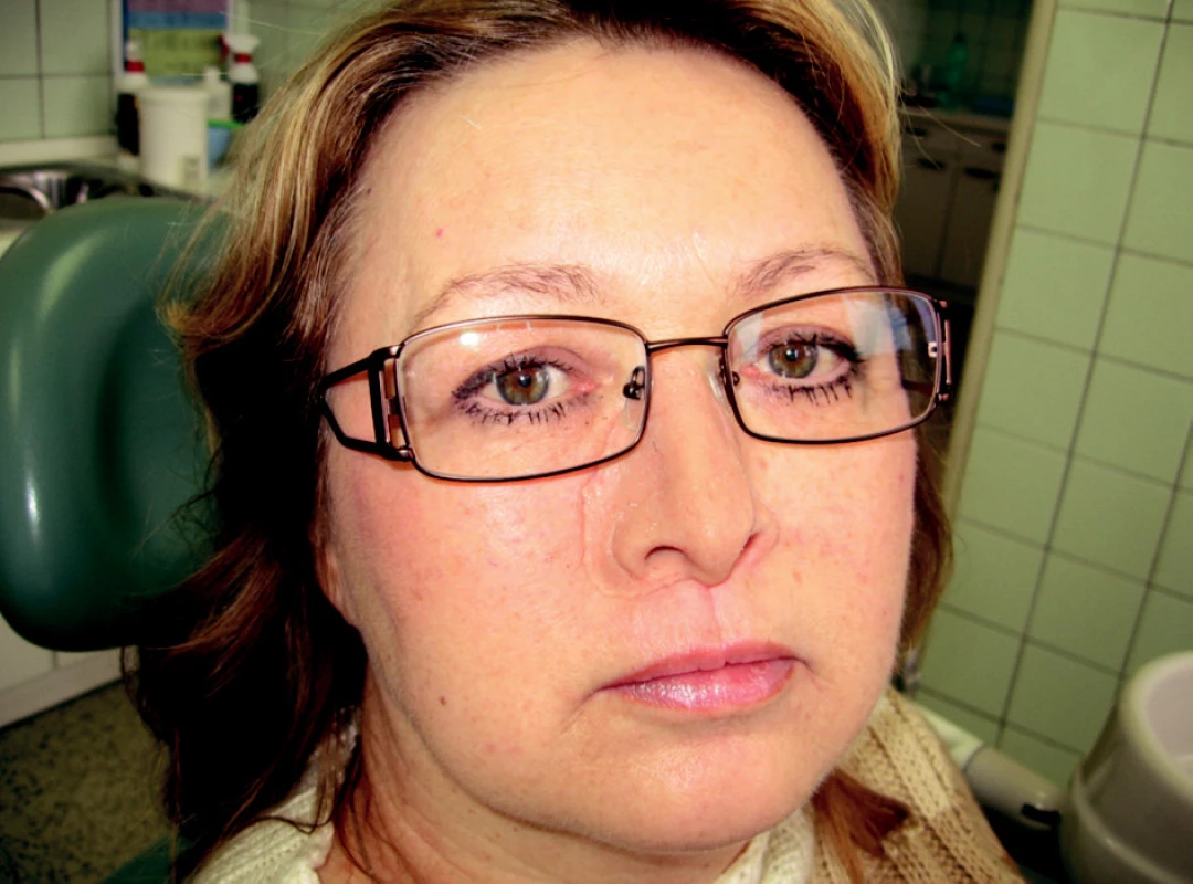 Nosní epitéza fixovaná na obličeji pomocí brýlí.