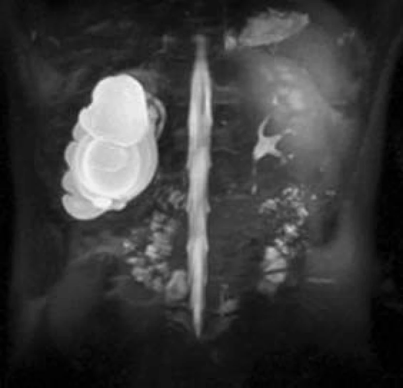 MR hydrografie u terminální hydronefrózy pravé ledviny. Dutý systém levé ledviny je štíhlý.