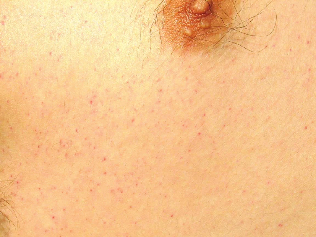 Syndrom tukové embolie – výsev kožních petechií (kůže hrudníku)