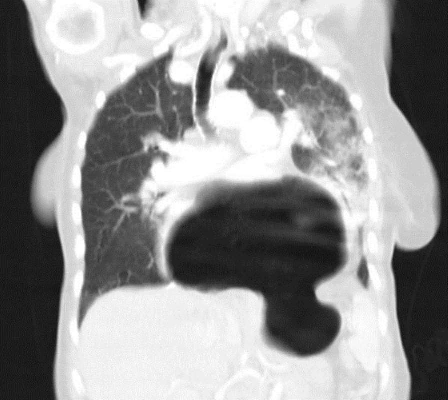 Frontální snímek CT
Fig. 10: Frontal CT image