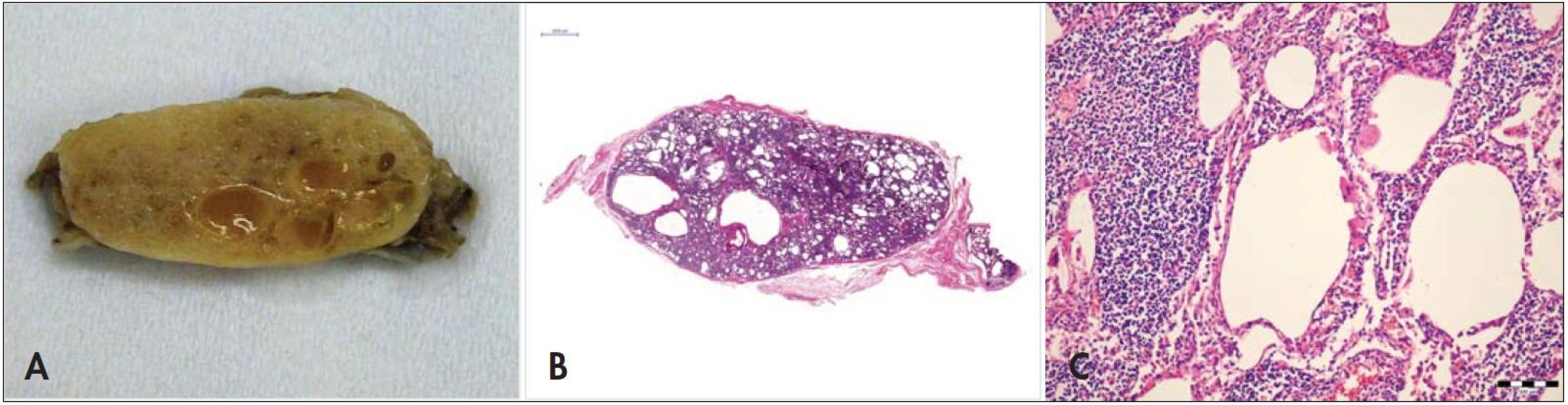 (A) Abdominálna lymfatická uzlina na reze. Je zachytená špongiovitá až cystická štruktúra spôsobená chylektáziami. (B) Histotopogram rezu lymfatickou uzlinou. (C) Histologický obraz pri veľkom zvätšení. Sú zachytené epiteloidné bunky s penovitou ružovou cytoplazmou obsahujúce mikroorganizmy a charakteristické chylektázie, hematoxylín-eozín, zvätšenie 200krát.