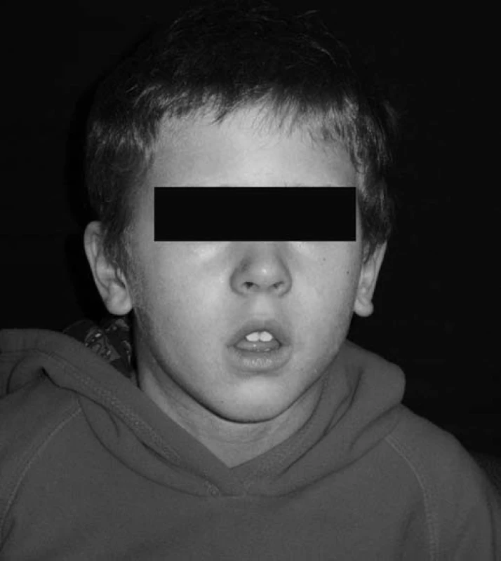 Typická facies adenoidea u pacienta č. 1.
Fig. 1. Typical adenoid face in patient No. 1.