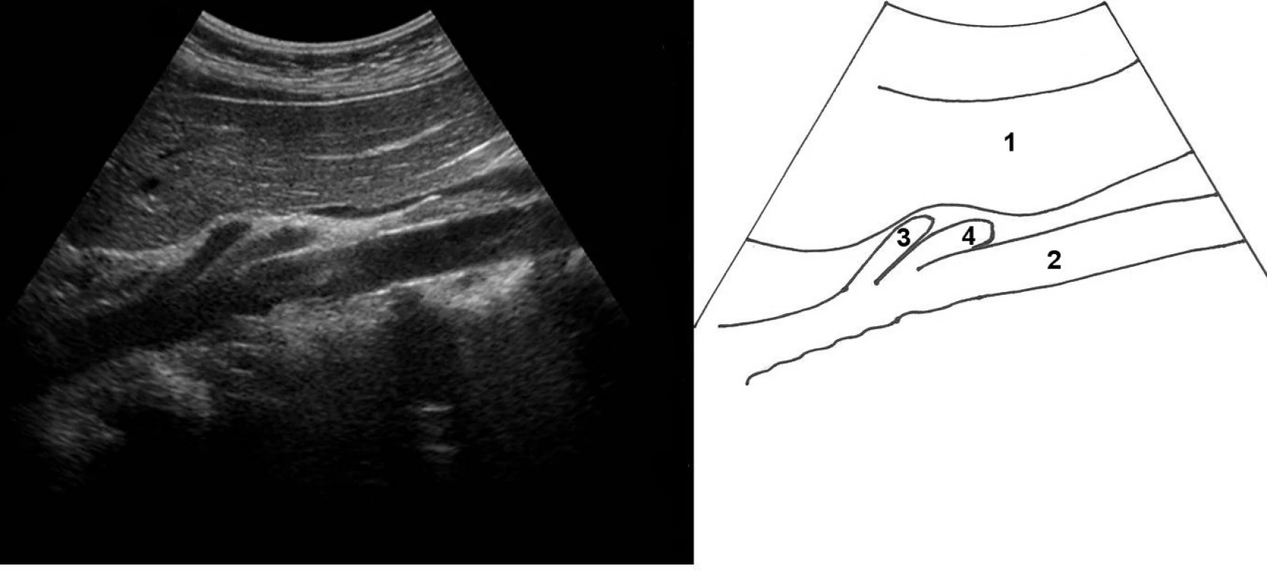 Podélné zobrazení odstupu hlavních epigastrických arteriální kmenů z aorty; 1 – levý lalok jater, 2 – aorta, 3 – truncus coeliacus, 4 – a. mesenterica superior