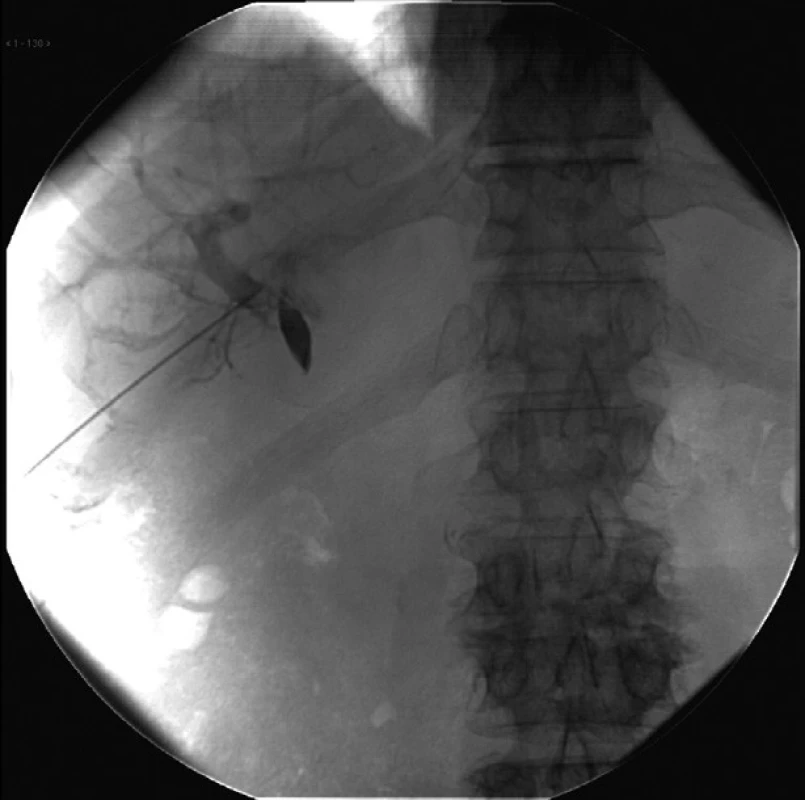 Napichnutie vnútropečeňovej portálnej žily punkčnou ihlou
Fig. 7: Puncture of intrahepatic portal vein by a puncture needle