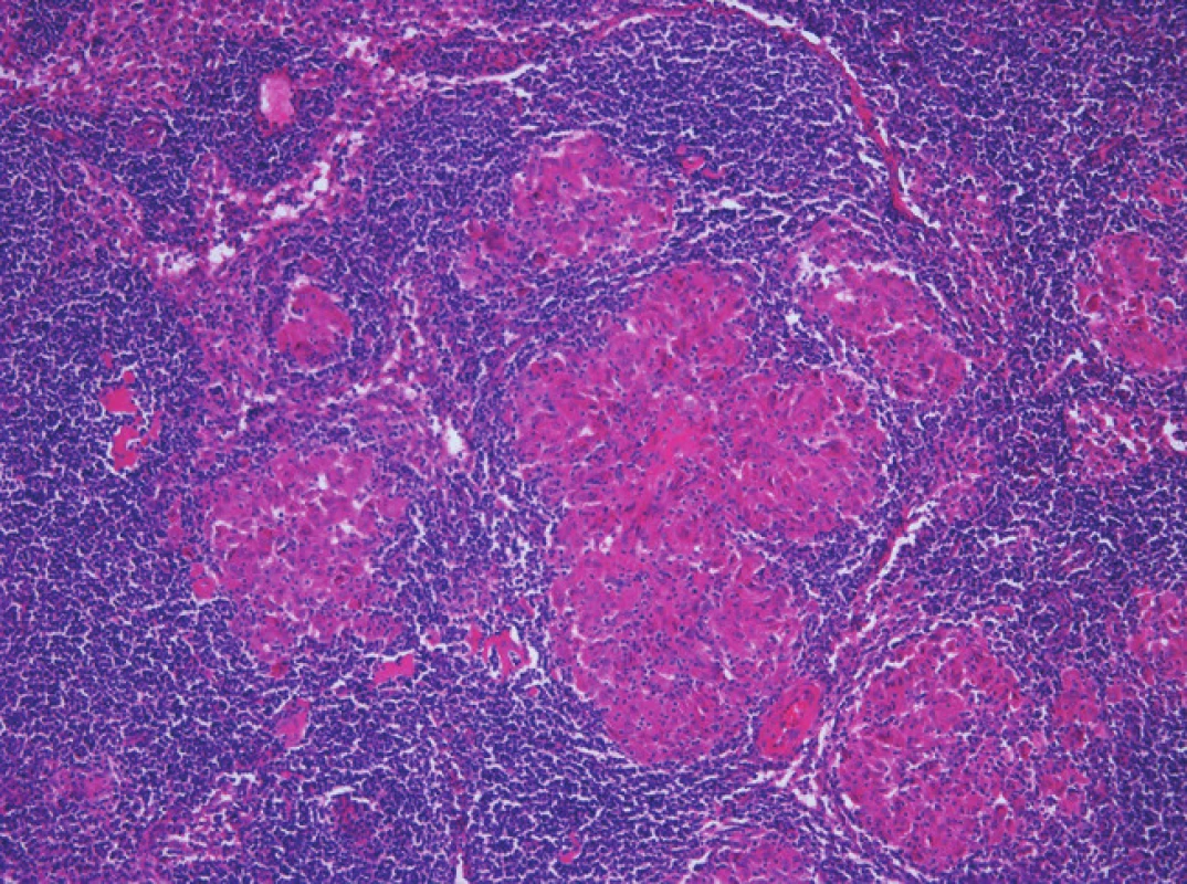 Granulomy nespecifického vzhledu zastižené v lymfatické uzlině
Fig. 6: Non-specific granulomas in lymph node