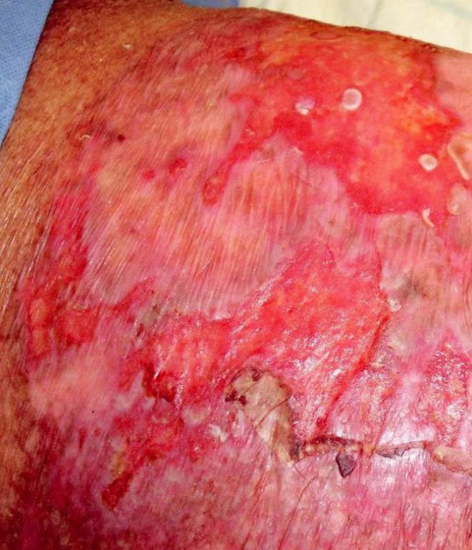 Kožní toxicita po chemoterapii IGEV u pacienta s Hodgkinovým lymfomem