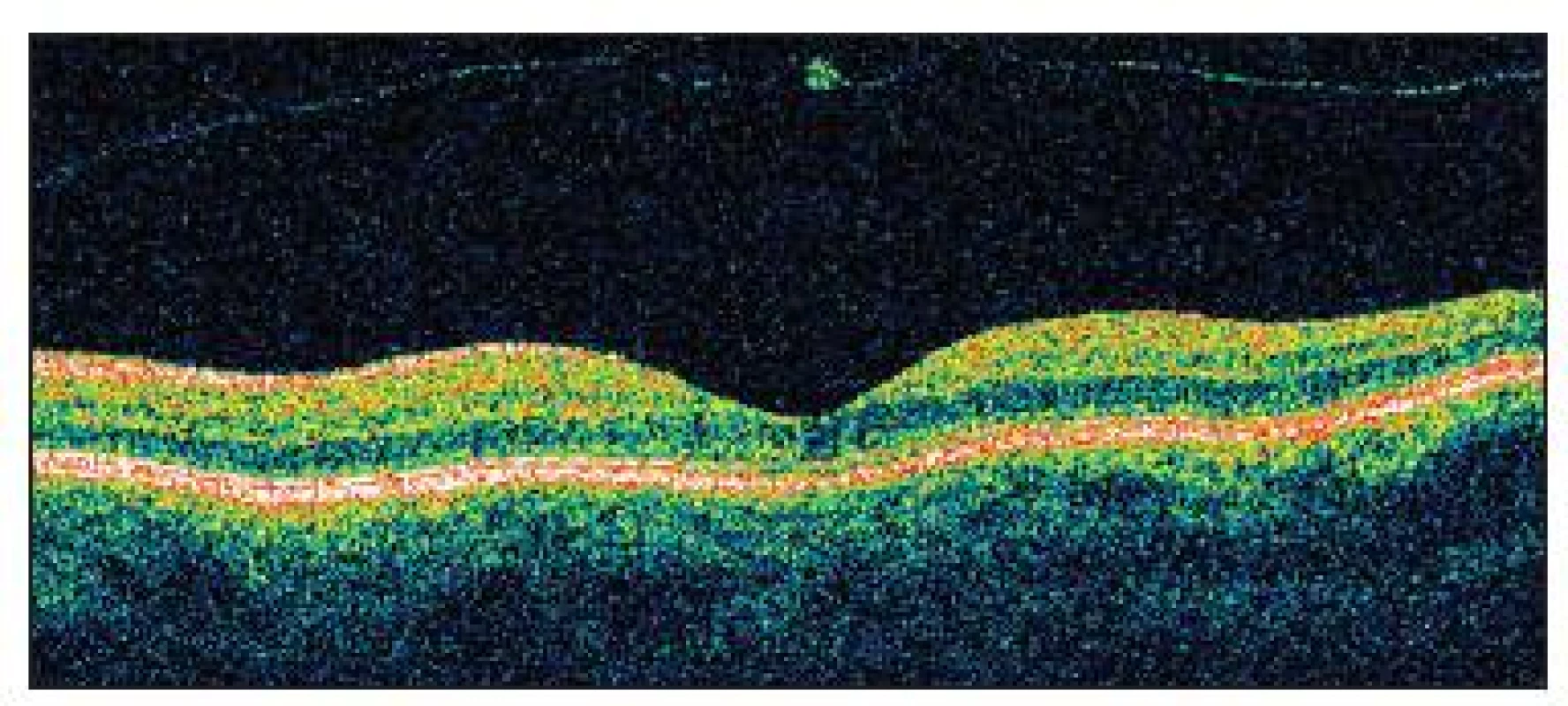OCT dokumentuje u pacientky č. 3 správnu architektúru fovey a flotujúcu zadnú kôru sklovca s drobným zahustením po vitreo- makulárnej adhézii, eventuálne aj s kúskom neurosenzorickej sietnice