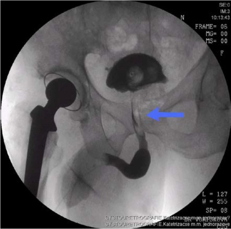 Cystouretrogram – defekt kontrastu v prostatické uretře
Fig. 1. Cystourethrogram – contrast defect of the prostatic urethra