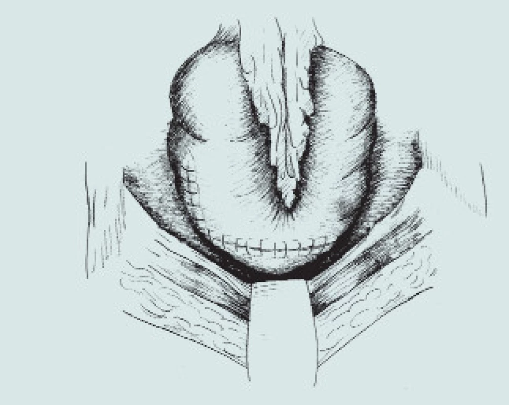Patch-cystoplastika s použitím colon ascendens.
(A – resekční linie močového měchýře a segmentu střeva, B – příprava detubularizovaného segmentu colon, C – sutura okrajů střevního segmentu, D – vytvoření kupole m.m., E – uzavření plastiky nízkotlakého močového měchýře)