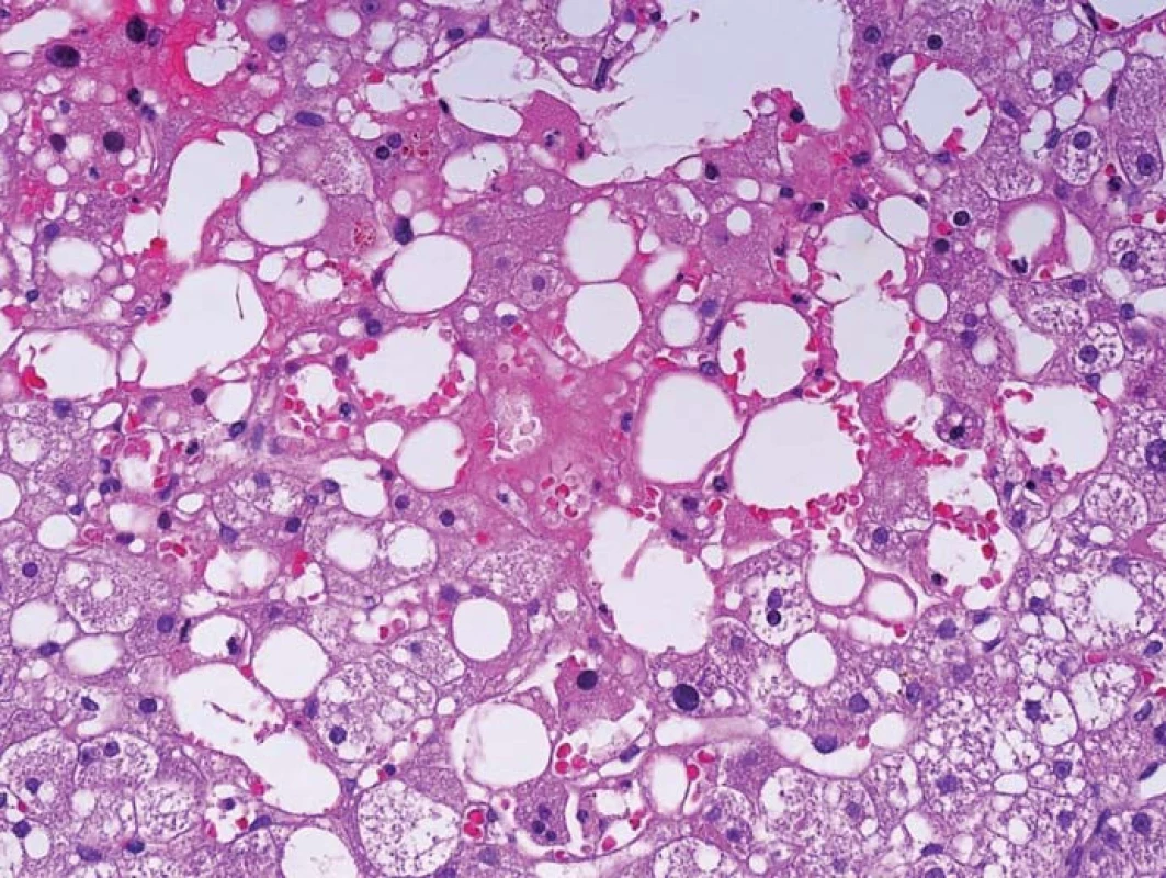 Centrolobulární oblast s objemnými splývajícími kapkami tuku, které místy vytvářejí jezírka a jsou i v sinusech, obklopené erytrocyty (lipopelióza).