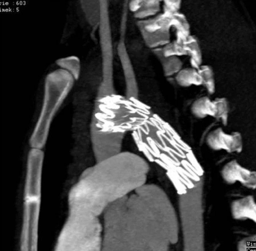 Kontrolní snímek 3 měsíce po implantaci stentgraftu
Fig. 3: Control X-ray picture 3 months after stent graft implantation