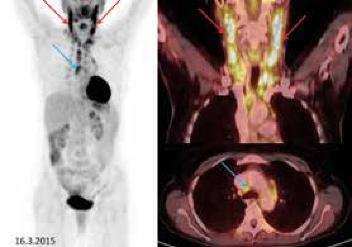Vlevo sumované obrázky (tzv. MIP), vpravo fúzované FDG-PET/CT koronární řezy (krk)
a axiální řezy (mediastinum).