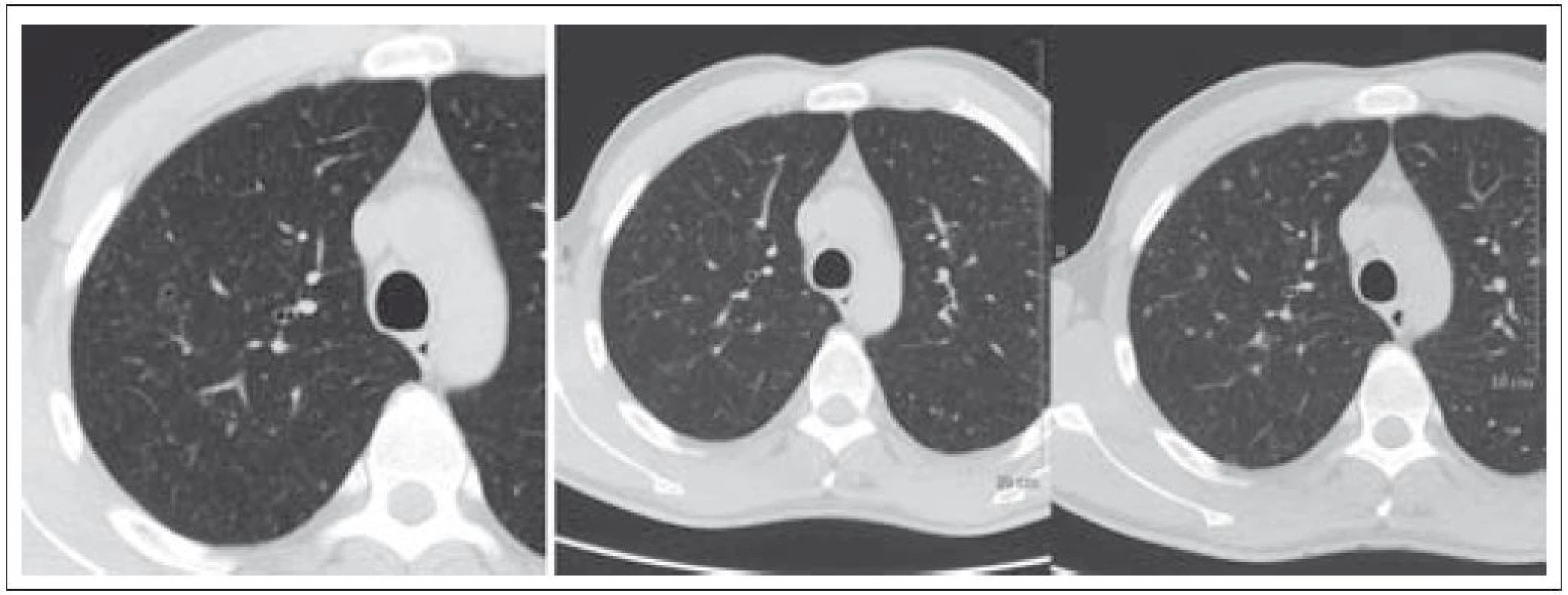 Pacient nar. 1973, HRCT ze dne 5. 11. 2009 a 28. 1. 2010. Drobné cysty a nodularity – patognomonický obraz LCH.