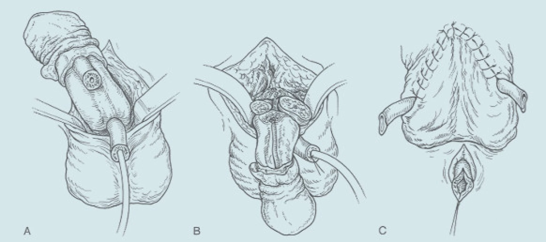 Radikální amputace penisu. Radikální amputace penisu. A: Uretra je izolována 2 cm proximálně od tumoru. Ligamentum suspensorium penis je přerušeno. Uretra je izolována od kavernózních těles a přerušena. B: Přerušení ligamentum suspensorium penis a ligatura dorzálních žil. Příčné přerušení kavernózních těles a jejich uzávěr matracovými stehy. C: Uretra je izolována, uvolněna od kavernózních těles a přerušena a podélně incidována. Uretra je vyšita jako perineální uretrostomie.