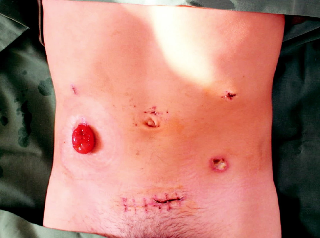 Pacient s FAP po laparoskopickej proktokolektómii s IPAA
Fig. 2. Patient with FAP after restorative proctocolectomy