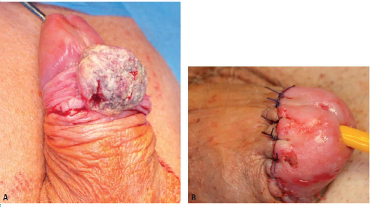 Muž, 73 let, dlaždicobuněčný karcinom penisu pT1G2 p N1 (pravé tříslo), řešeno excizí tumoru a radikální ilioinguinální lymfadenektomií vpravo
Fig. 2. Man, 73-year-old, squamous cell carcinoma of the penis pT1G2 pN1 (right groin), treated with excision and radical ilioinguinal lymphadenectomy