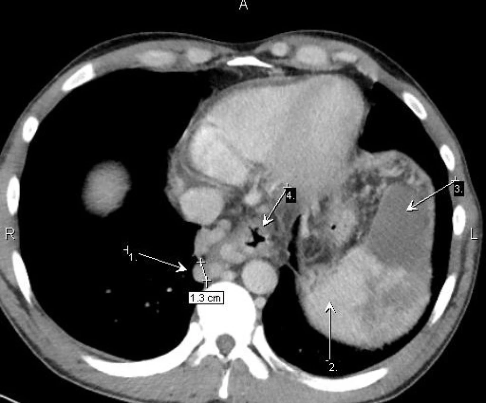 Kontrastní CT, řez ve výši bránic 
Vlevo opacifikující se slezina (2) a její hypodenzní, neopacifikující se infarkt (3). Ztluštělá stěna distálního jícnu (4), kde v jeho okolí jsou extrémně široké varixy (1).