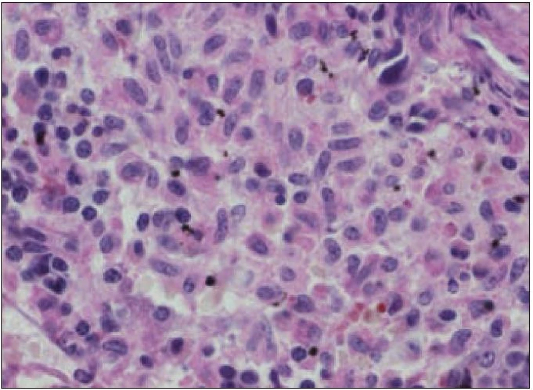 Mastocyty v kostní dřeni. Velký denzní agregát více než 15 mastocytů. Přes 25 % mastocytů má patologickou moroflogii - atypické, vřetenité i nezralé formy. Barveno PAS, zvětšení 400krát. Snímek MUDr. Leoš Křen, Ph.D.