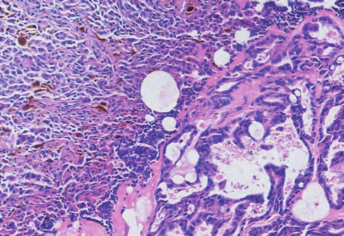 Metastáza melanomu v mízní uzlině s pigmentem (vlevo) a papilární adenokarcinom (vpravo). Hematoxylin &amp; eosin, originální zvětšení 200x.